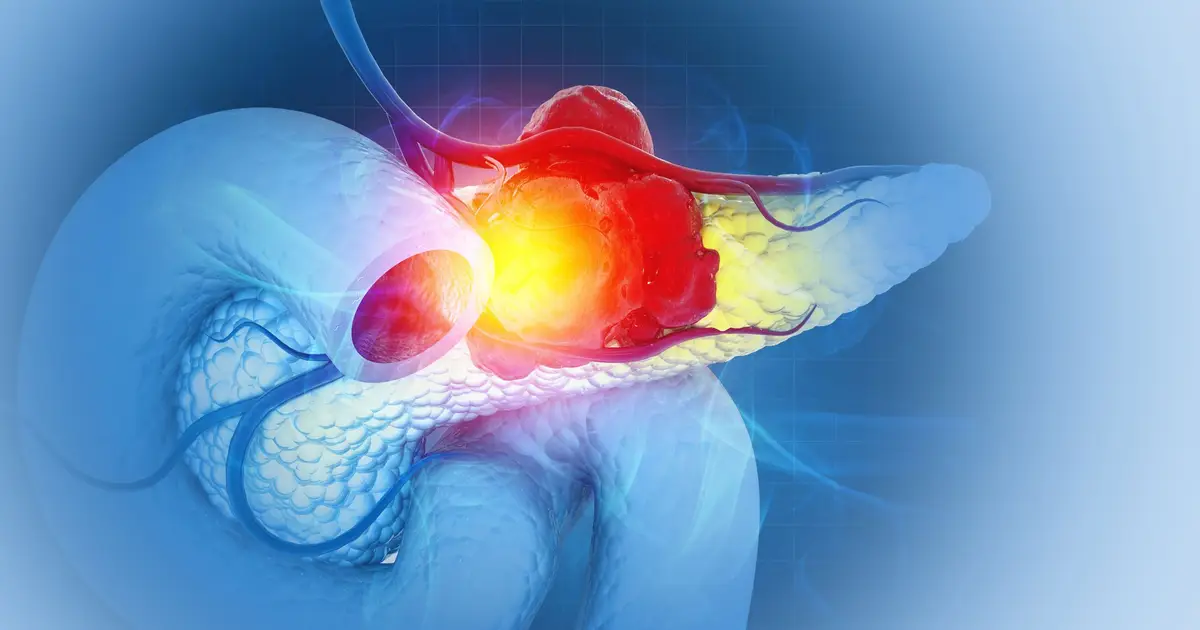 New triple - drug treatment stops pancreatic cancer in its tracks , a mouse study finds