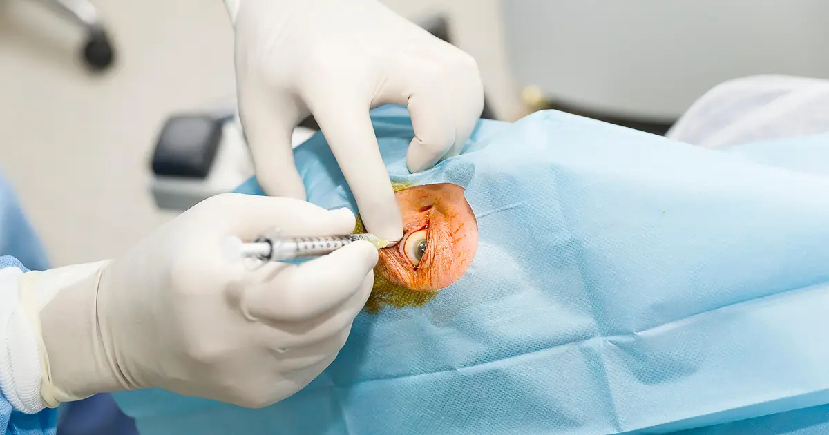 Real-World Treatment Choices for AMD