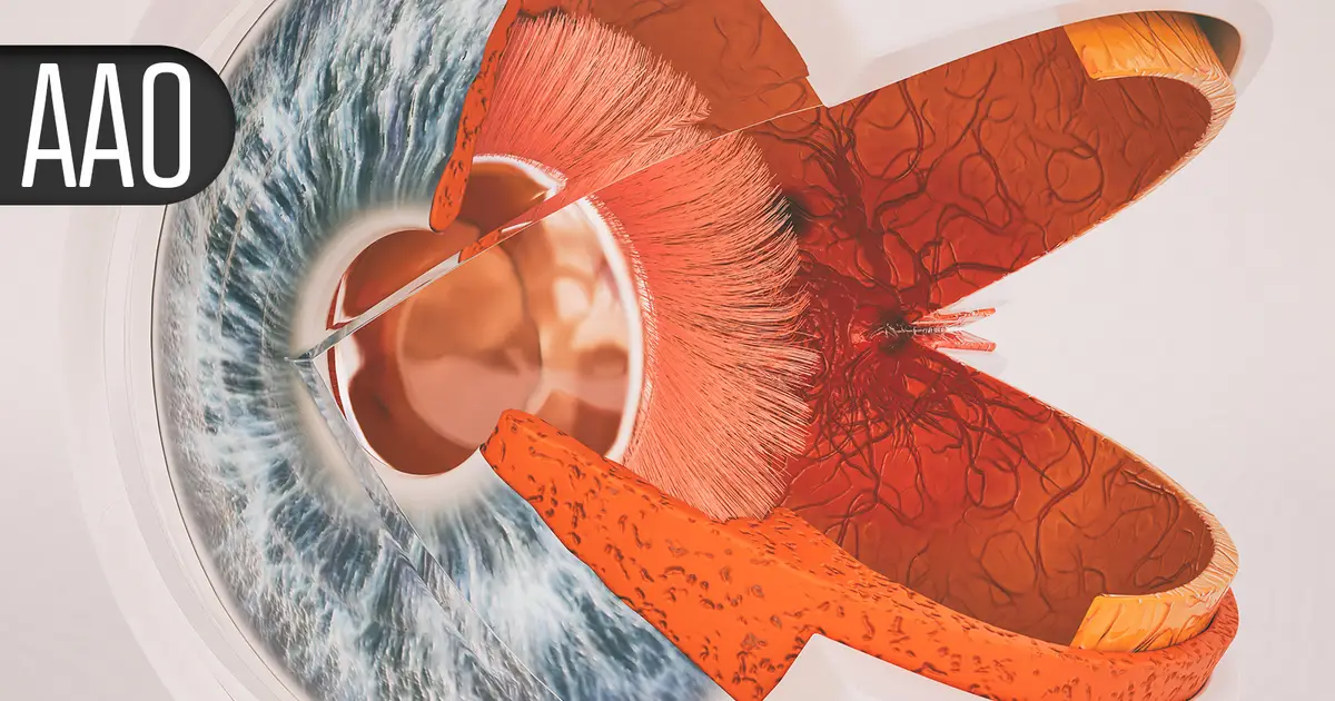 Geographic Atrophy Growth Rate Reduced by Half With Anti-Inflammasome Implant
