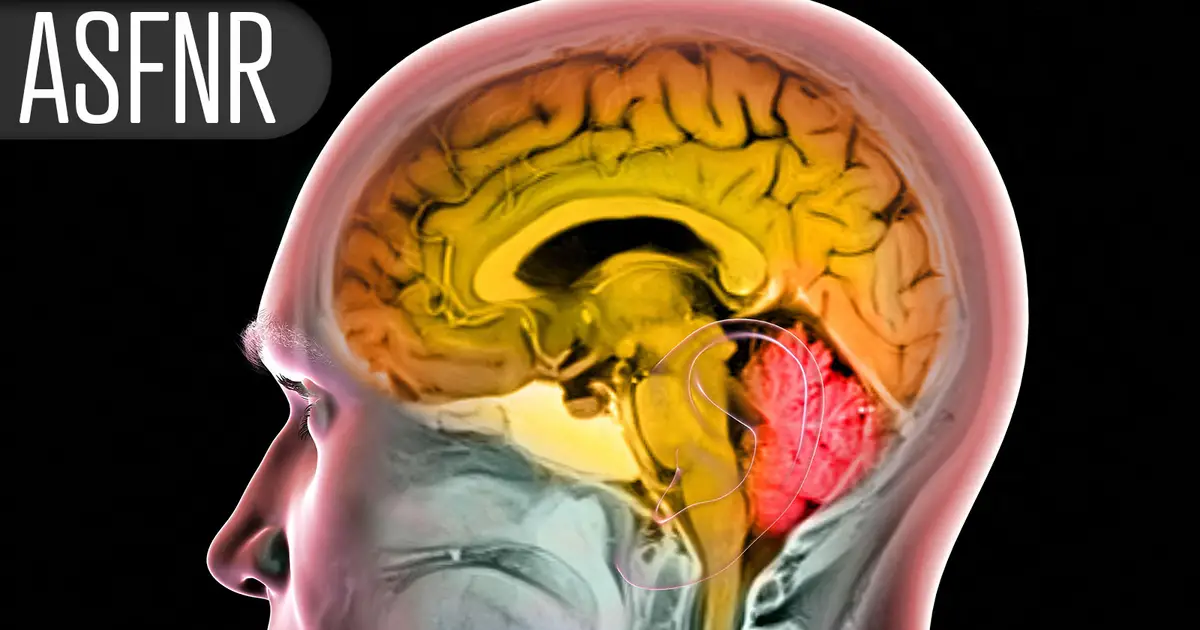 Perfusion Mismatch Ratio Predictive in Medium Vessel Occlusion Strokes