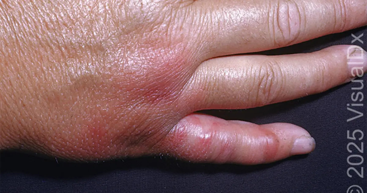 Make the Diagnosis: What Caused This Patient’s Painful, Edematous Hand?