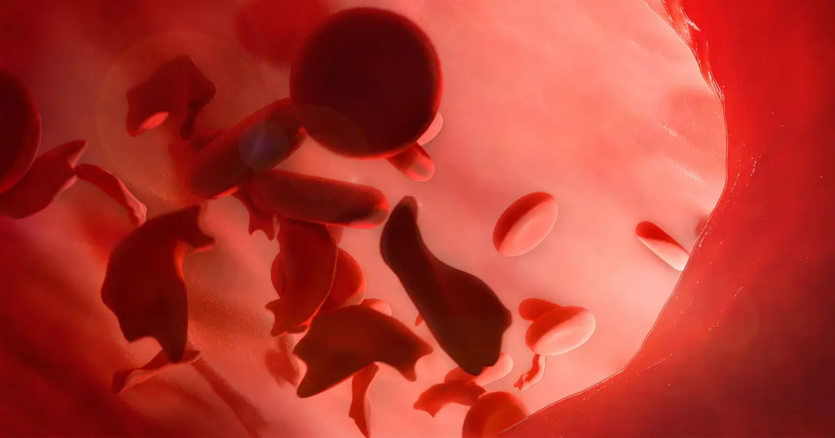 Sickle Cell Disease and Cancer Risk