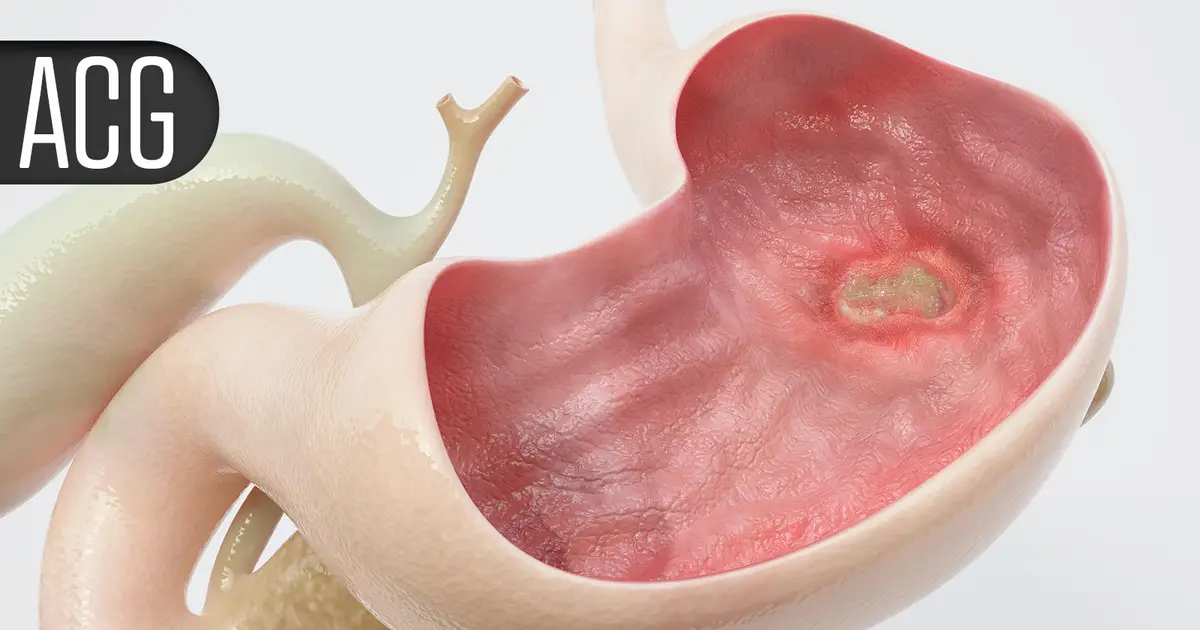 Fast-Acting Pill Reduces Heartburn Frequency in Non-Erosive Reflux Disease