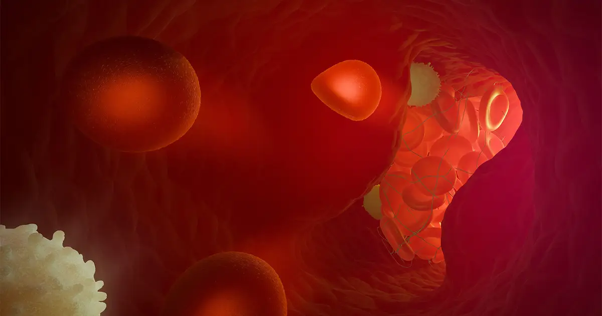 Endovascular Therapy Eyed for Milder Strokes, Later Time Window