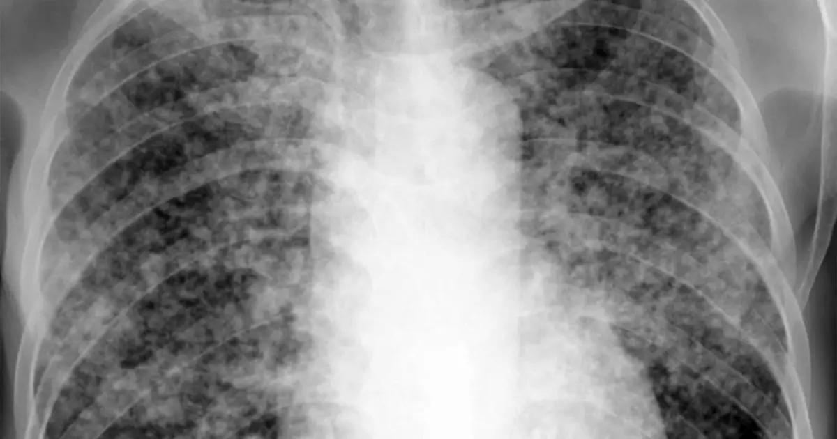 Novel Sarcoidosis Drug Fails to Improve Steroid Dose Reduction