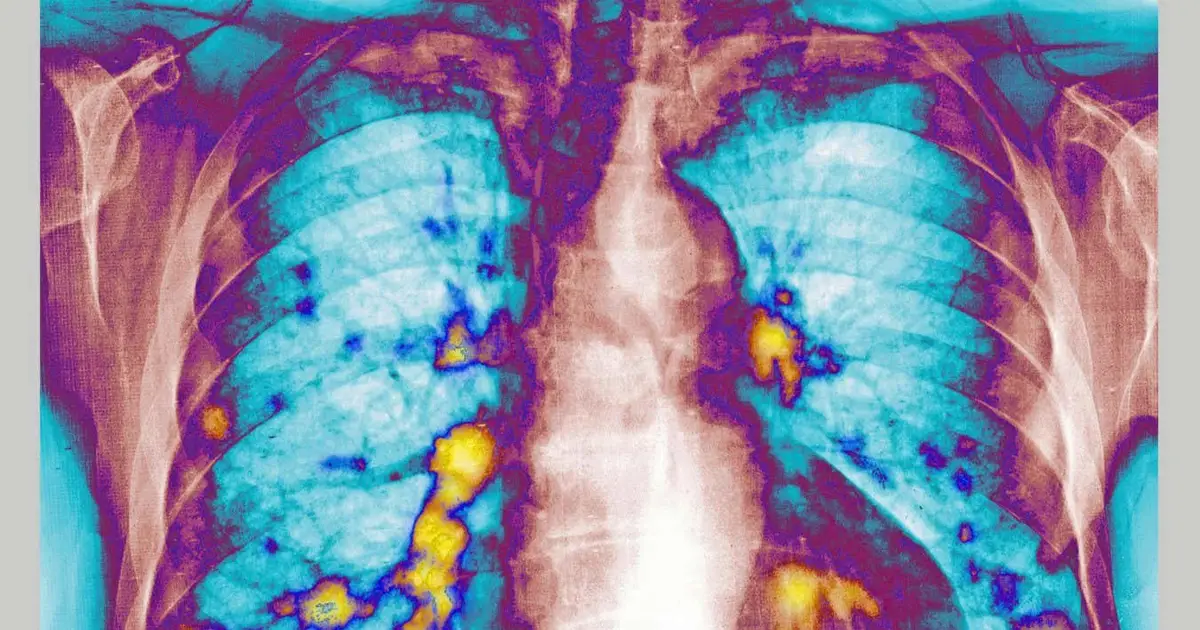Catching a cold can delay cancer from spreading to the lungs