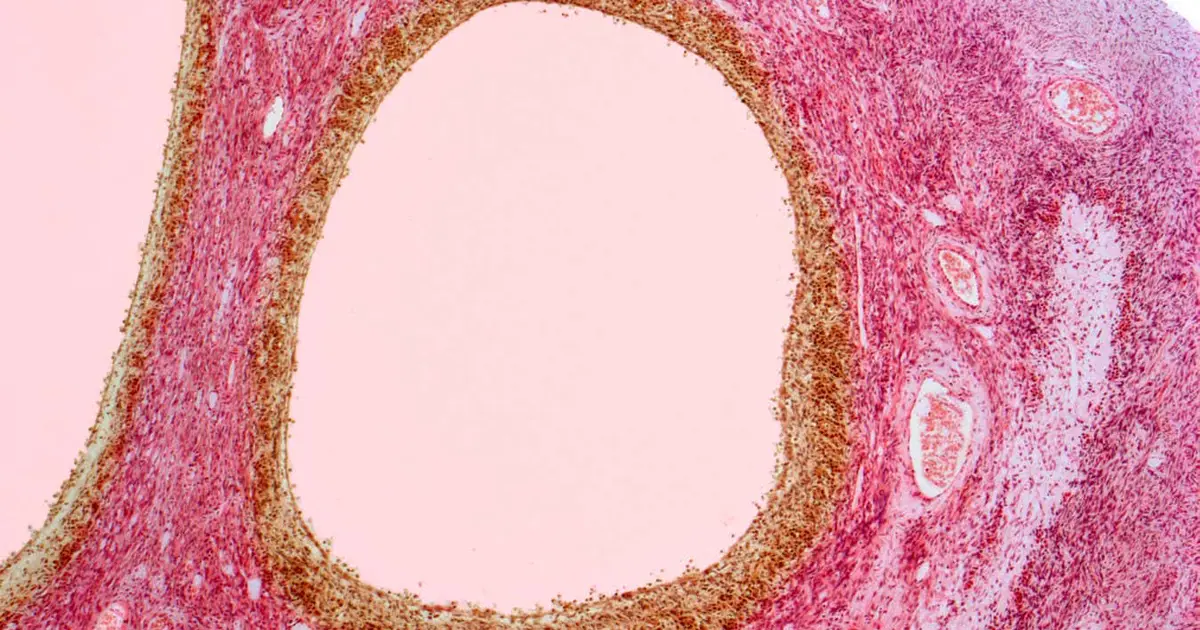 PCOS has been officially renamed PMOS, and it’s a momentous move