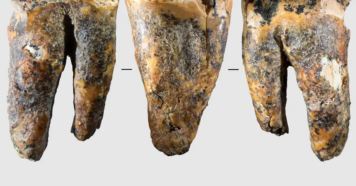 Neanderthals treated a dental cavity by drilling into the tooth