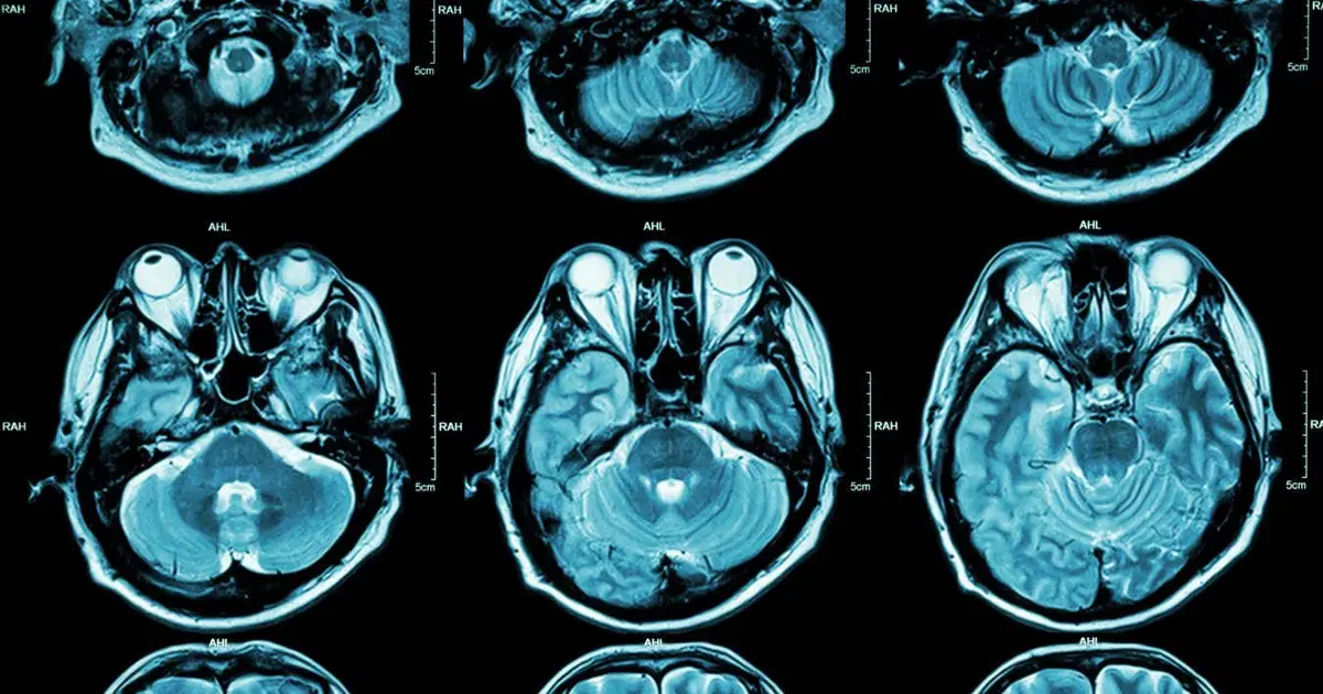 Autism may have two distinct subtypes that vary by brain activity