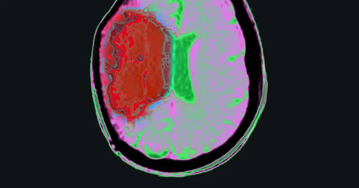 Chilling the body with drugs could limit brain damage from stroke
