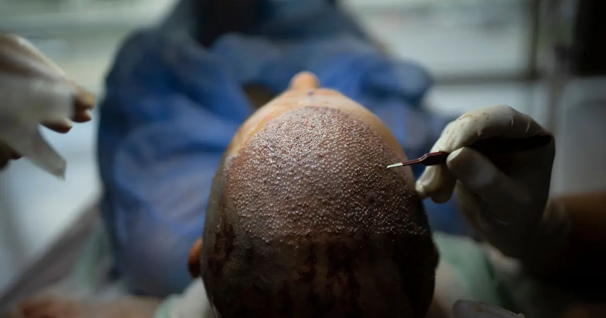 How Turkey Hacked the Hair Transplant Industry