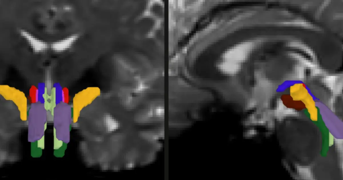AI algorithm enables tracking of vital white matter pathways