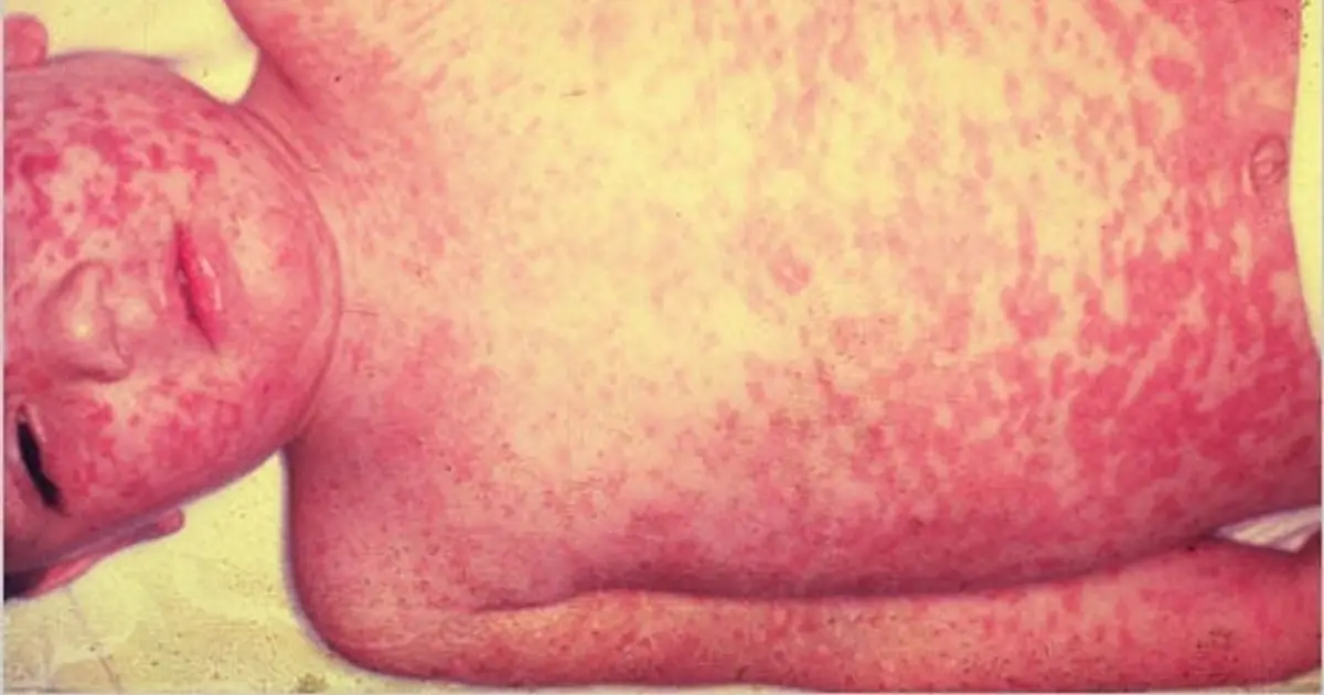 Ave Maria clinic numbers reflect slowing of measles cases , last positive case was Monday ; vaccination recommended