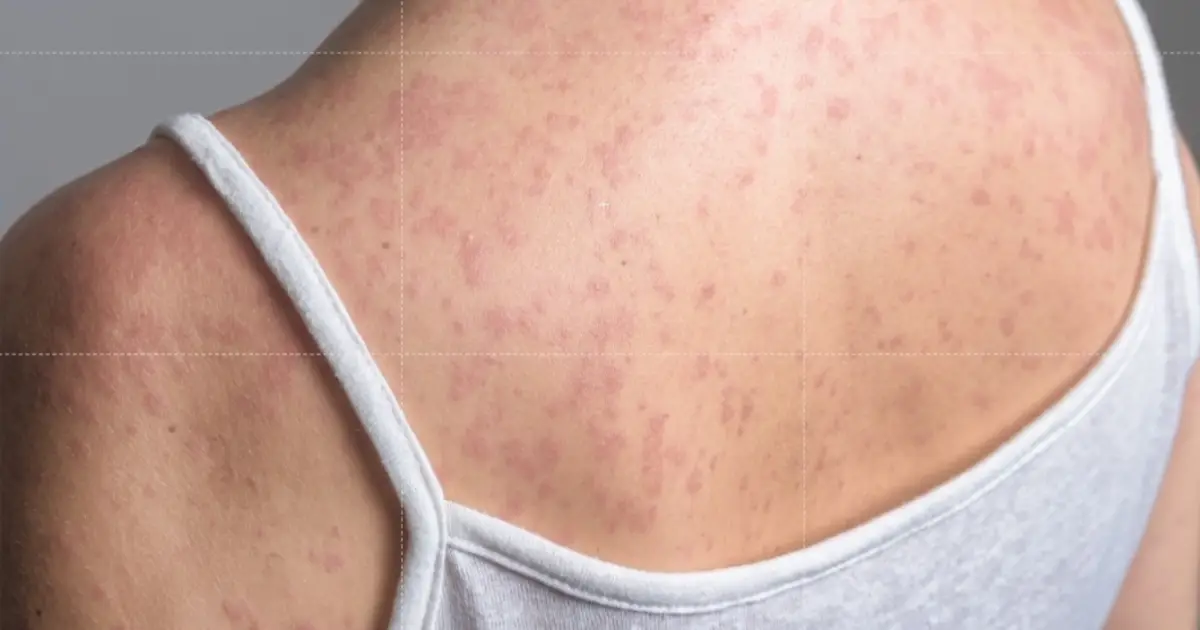 Measles At 33 - Year High : See Risk Level In Glastonbury