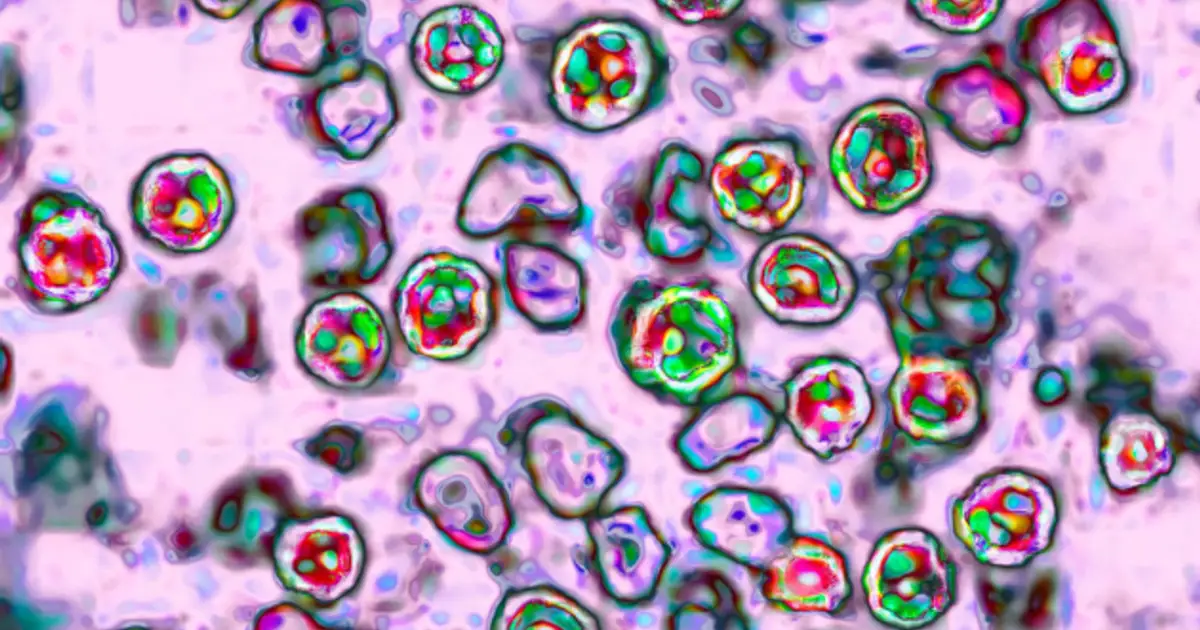 Nearly 800 cases in South Carolina record - breaking measles outbreak