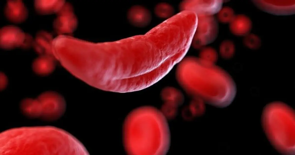 Study finds regional differences in sickle cell disease in New York state
