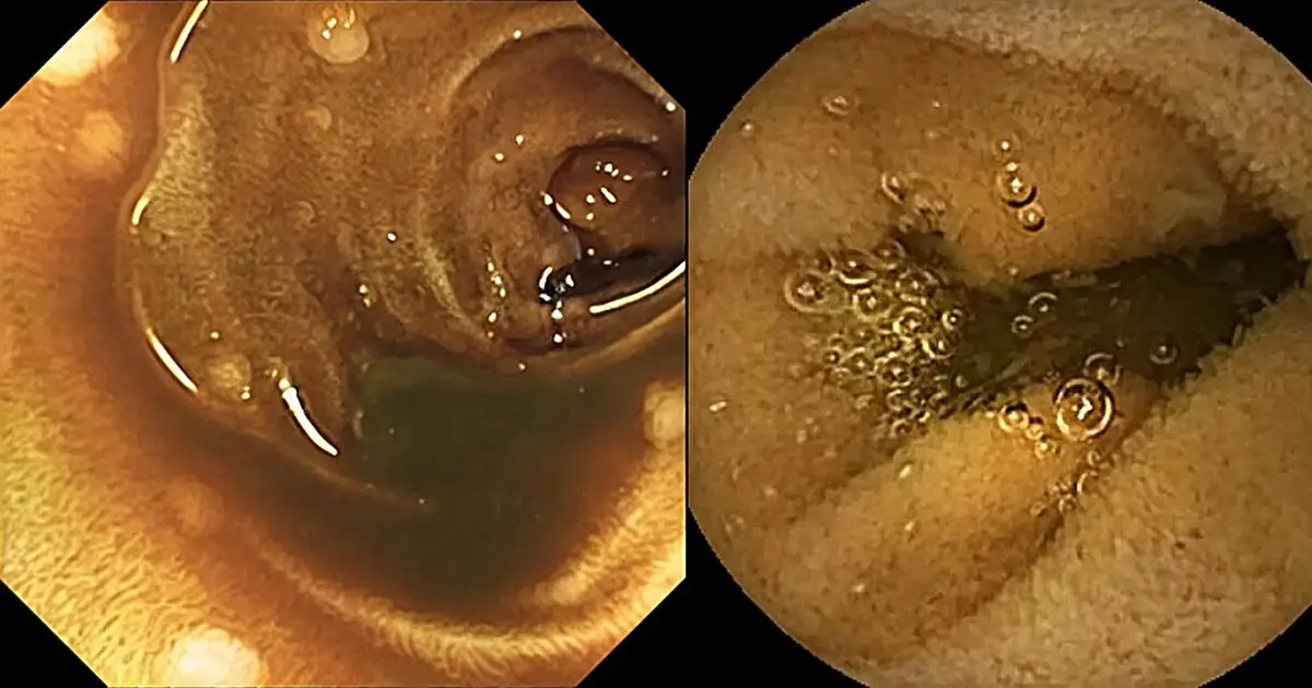 AI helping doctors to detect intestinal disease