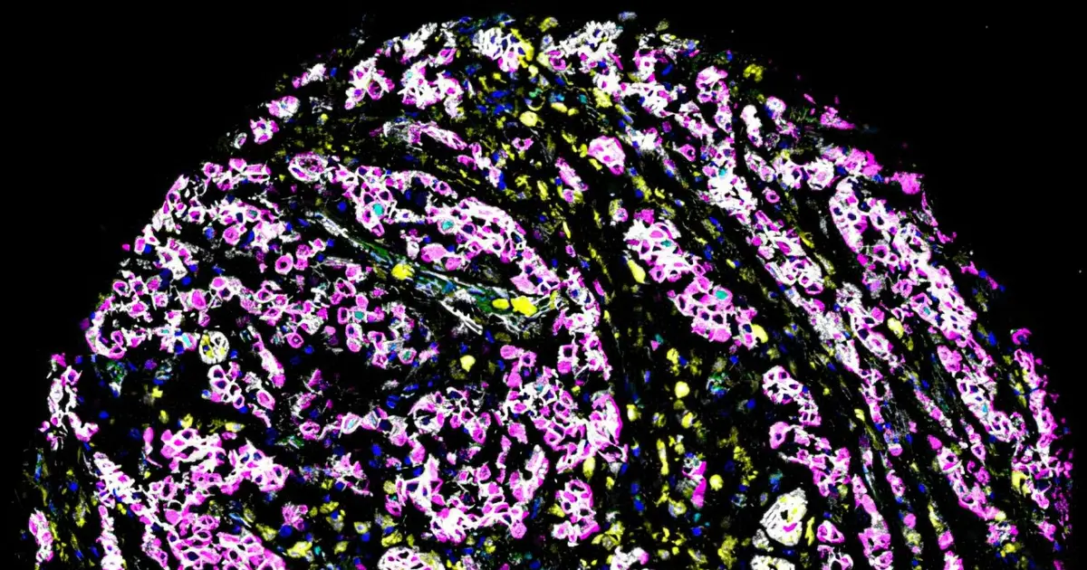 AI reveals distinct cell defects inside breast cancer