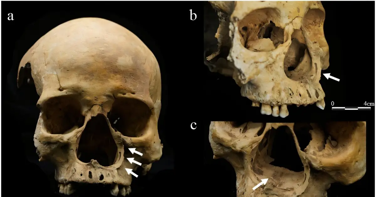 Medieval Chinese skeleton may reveal first evidence of a brutal punishment