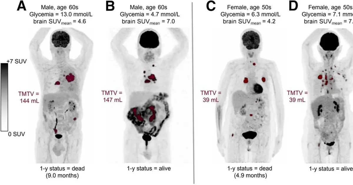 Brain metabolism predicts survival in advanced non–small cell lung cancer patients