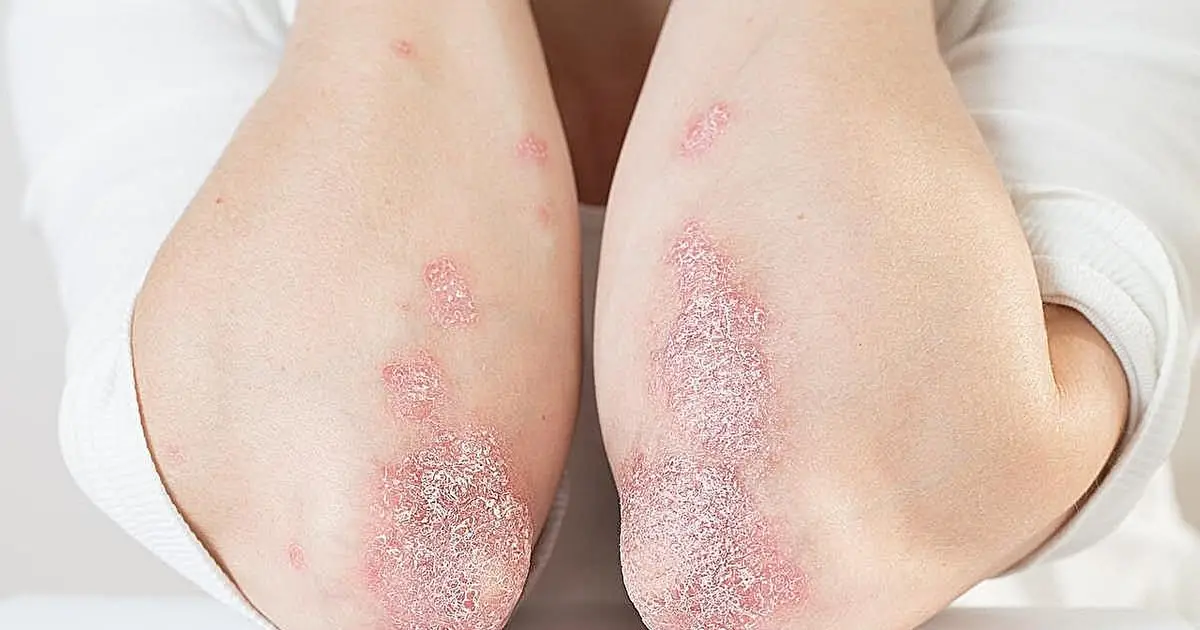 Burden of myocardial dysfunction elevated for individuals with psoriasis