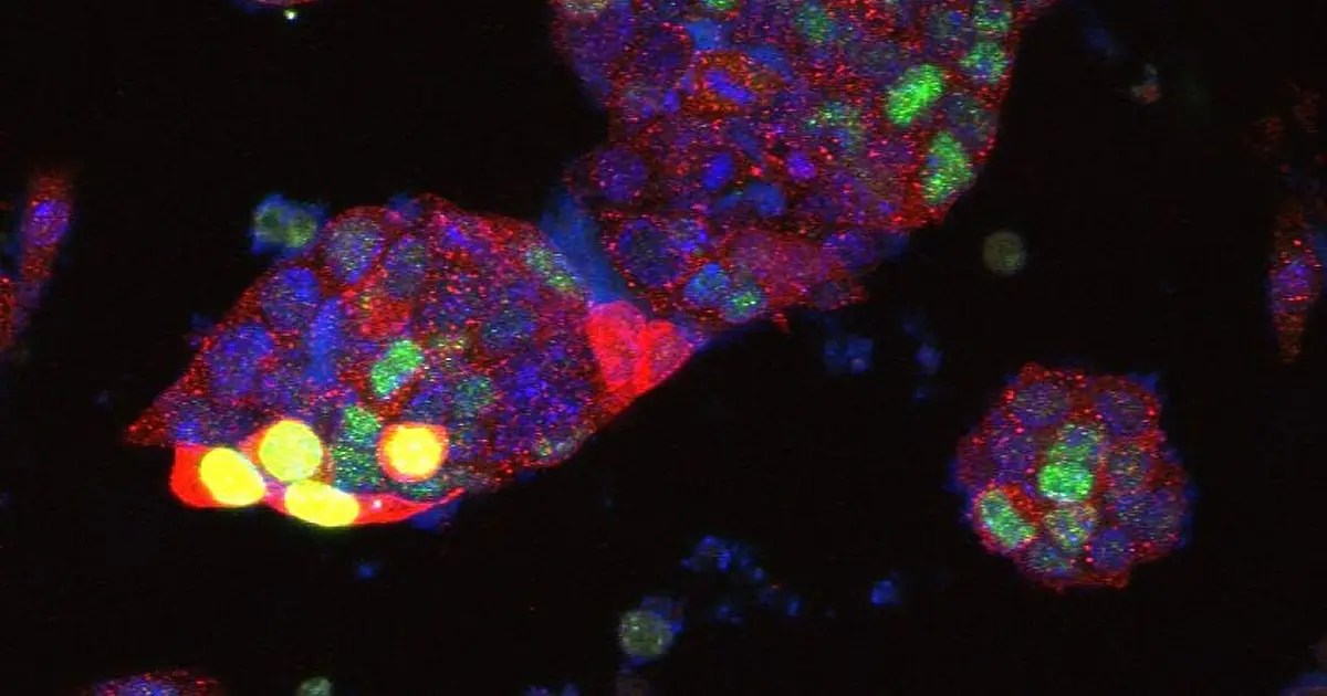 Chain reaction that begins when tumor suppression gene is switched off offers clues to how cancer develops