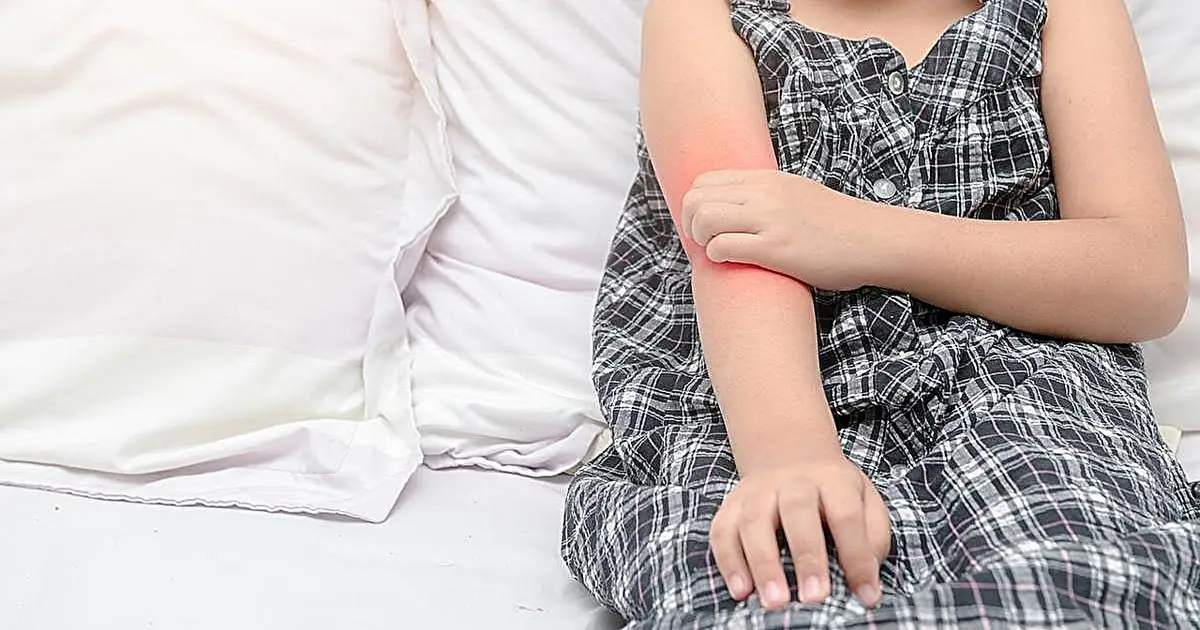 Children, teens have higher psychological burden of atopic dermatitis