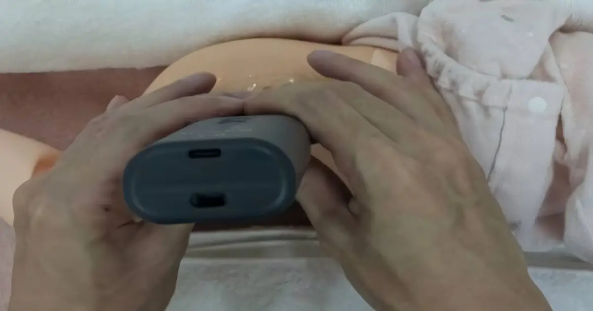 Community-based baby hip screening successfully reduces late diagnosis of developmental dysplasia