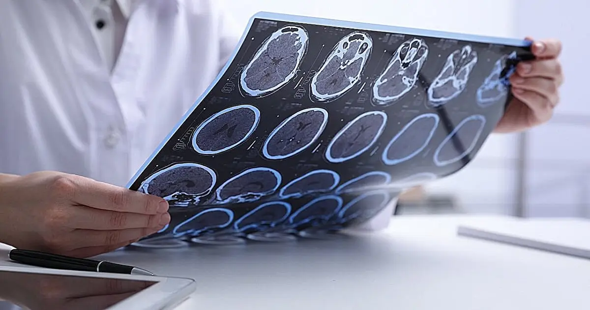 Early MS treatments impact relapses and brain scarring differently, but not disability
