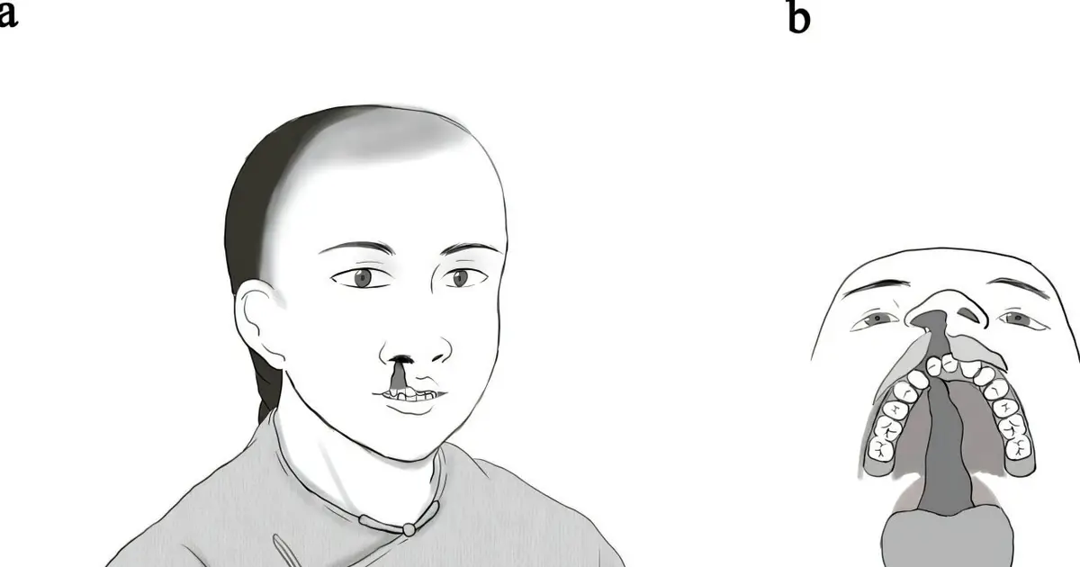 First archaeological case of cleft lip identified in China reveals inclusive care in Qing dynasty community
