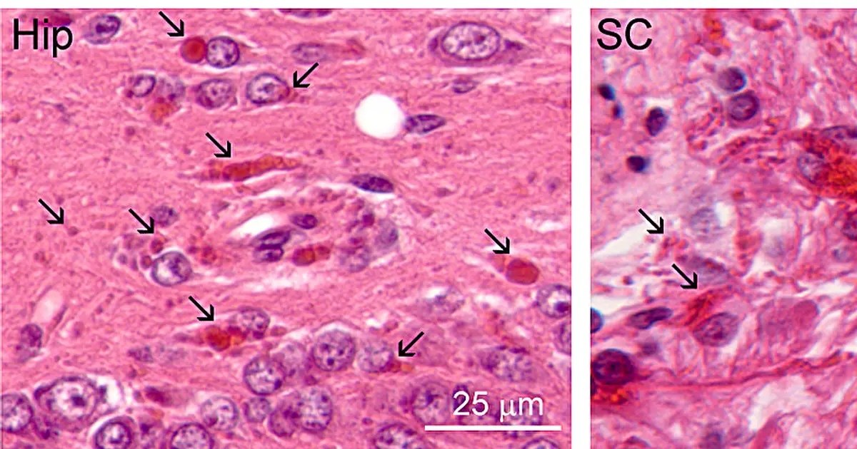 First drug to treat Alexander disease approved by the FDA after three decades of research