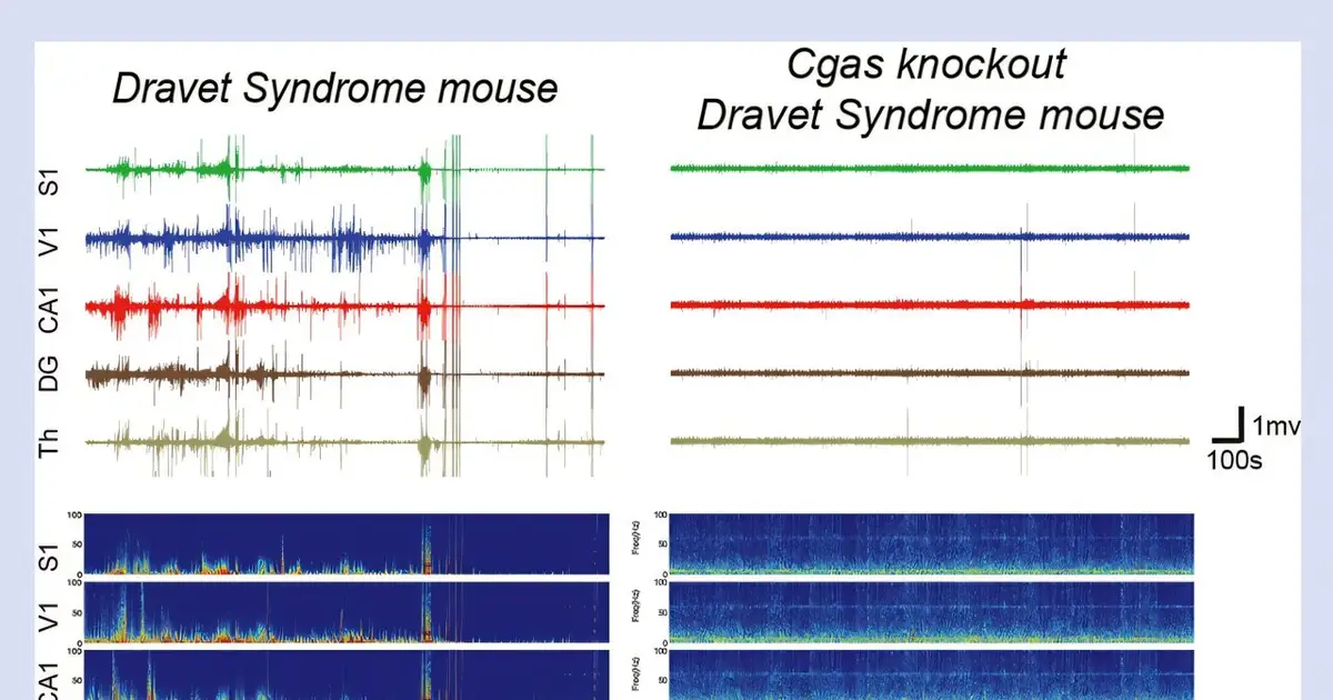Inflammation may drive Dravet syndrome, offering a potential new treatment target