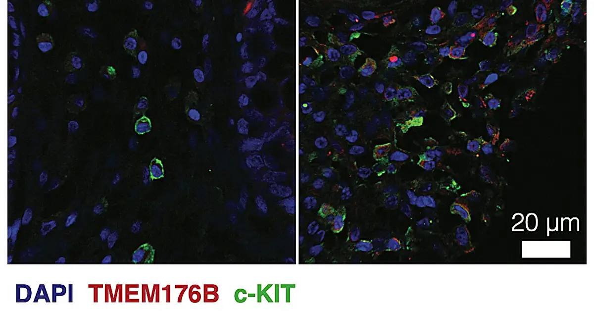 'Invisible' inflammation in rare bowel disease may explain heightened colon cancer risk