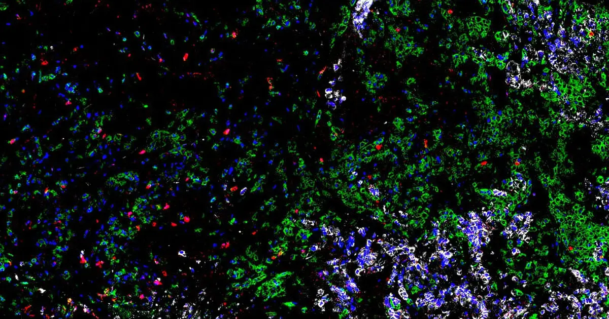Lab-grown tumors reveal immune cells capable of killing small cell lung cancer