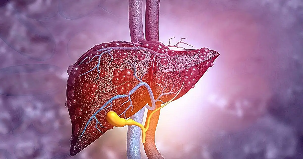 Link between liver fibrosis in MASLD, ASCVD varies by glycemic status