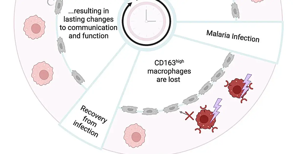 Malaria can permanently deplete spleen macrophages that filter blood and recycle iron