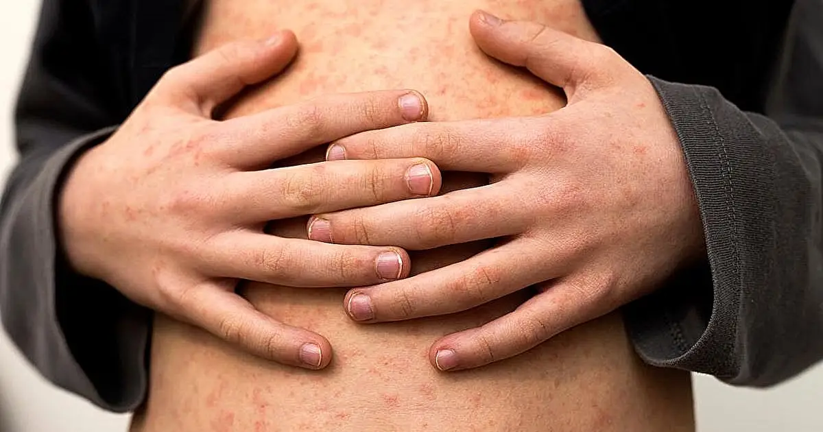 Measles cases set 35-year US record with months to go in 2026