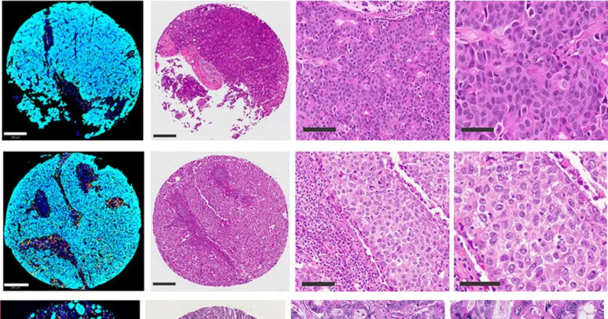 New topology-based biomarkers may improve breast cancer prediction