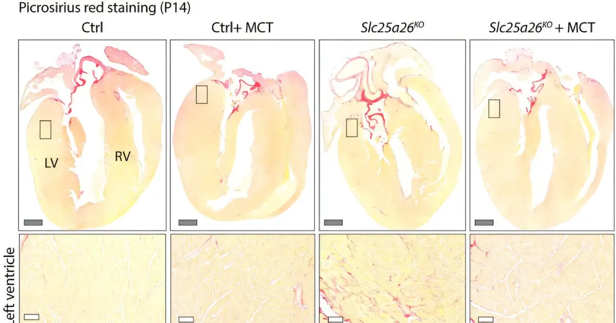 Metabolic vulnerability identified that may affect heart development