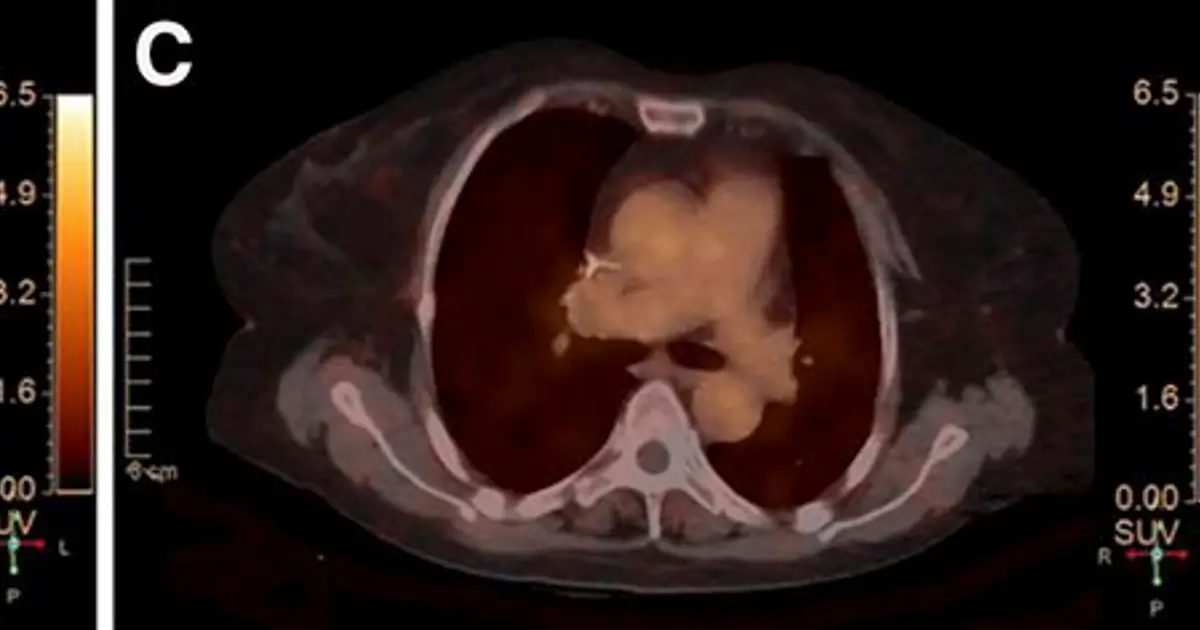 Molecular imaging demonstrates promise for predicting complete pathologic response in HER2-positive breast cancer