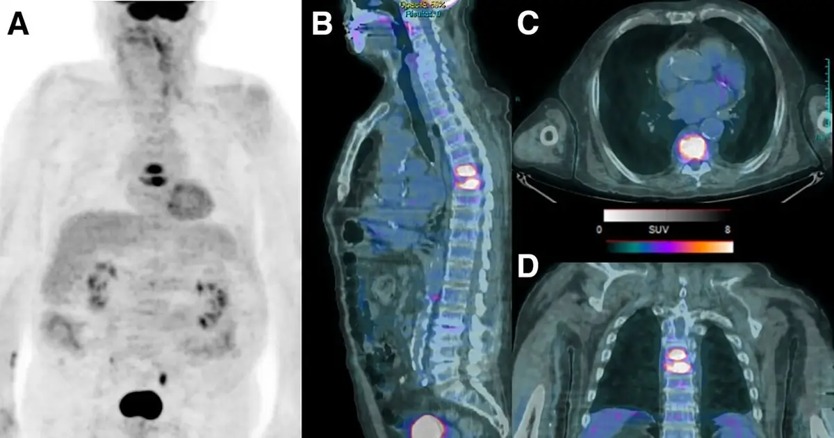 Molecular imaging enhances diagnosis of fever of unknown origin
