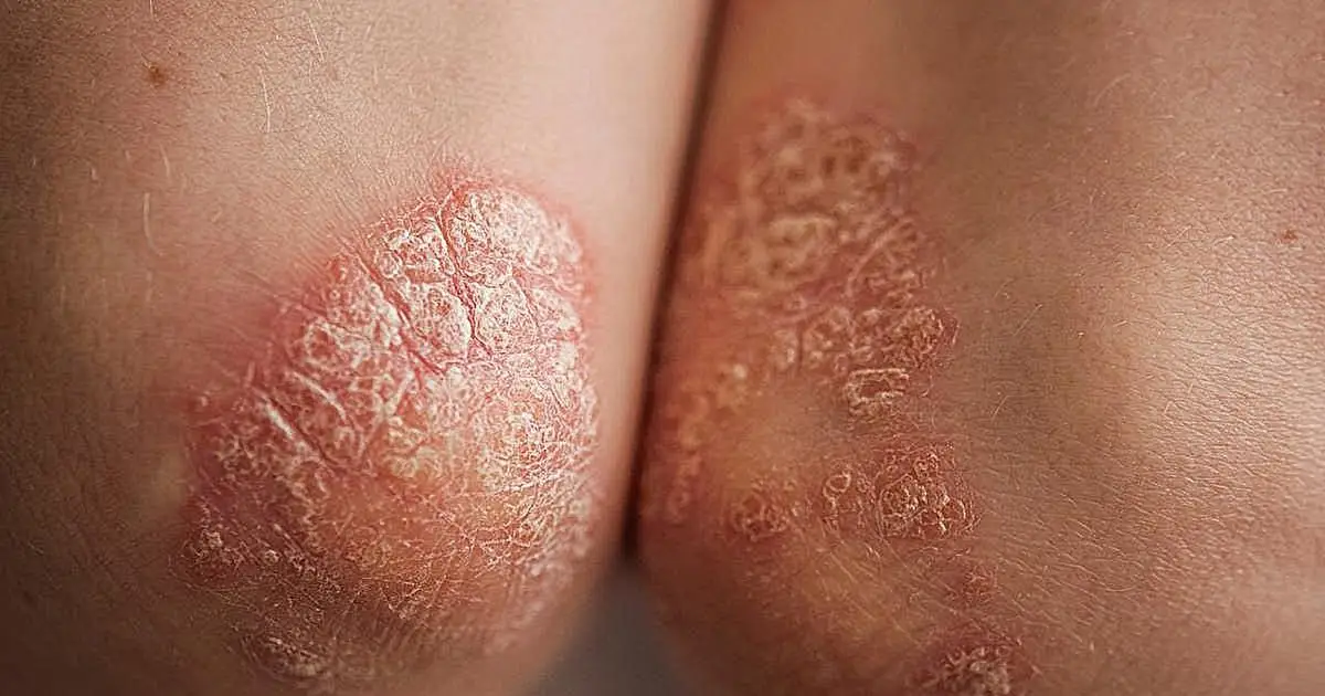 Mortality, comorbidity risk increased with generalized pustular psoriasis