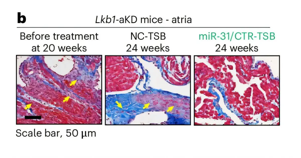 New treatment reduces heart scarring and abnormal heart rhythms, offering a possibility for future therapies