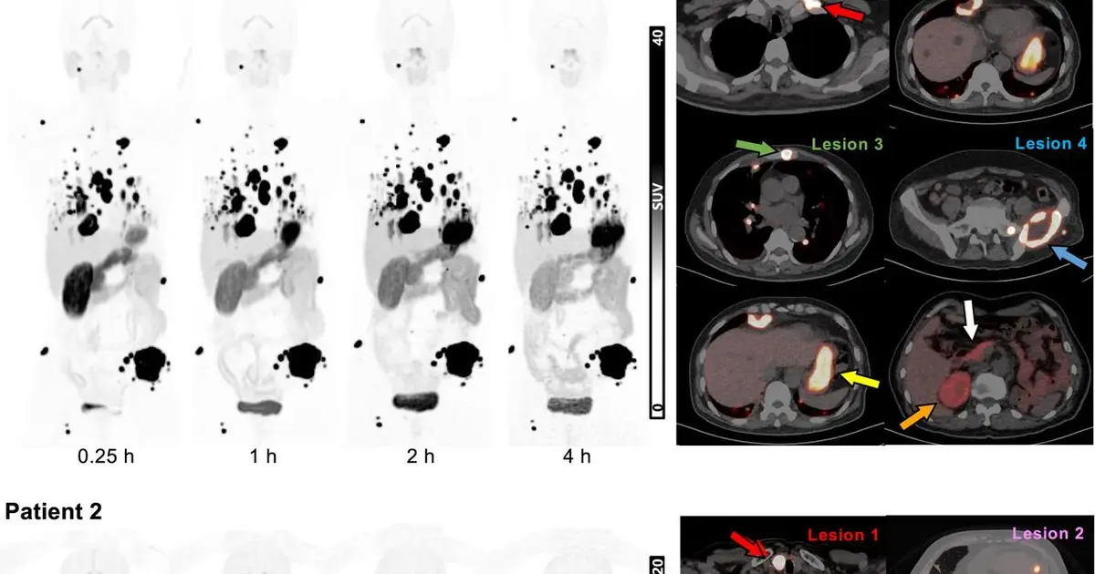 Next generation theranostic pair offers new strategy to detect and treat metastatic kidney cancer