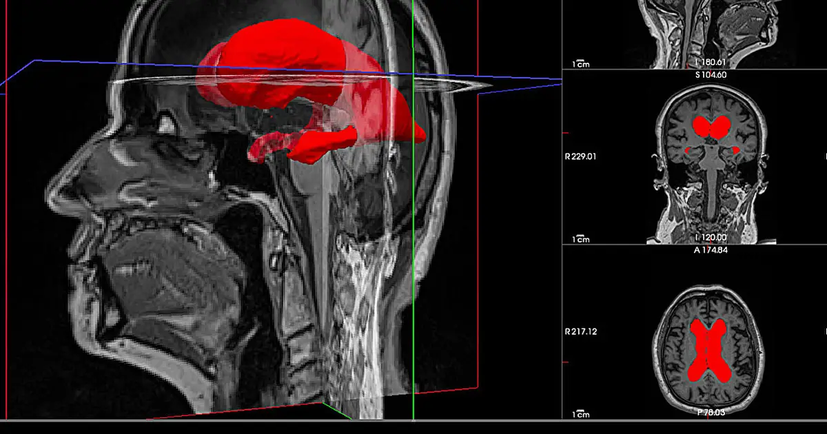 Novel 3D brain marker predicts surgical success in dementia-causing hydrocephalus