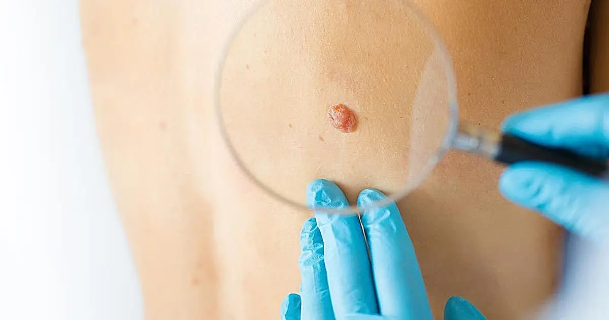 Personalized vaccine helped melanoma patients stay cancer-free longer, drugmakers say
