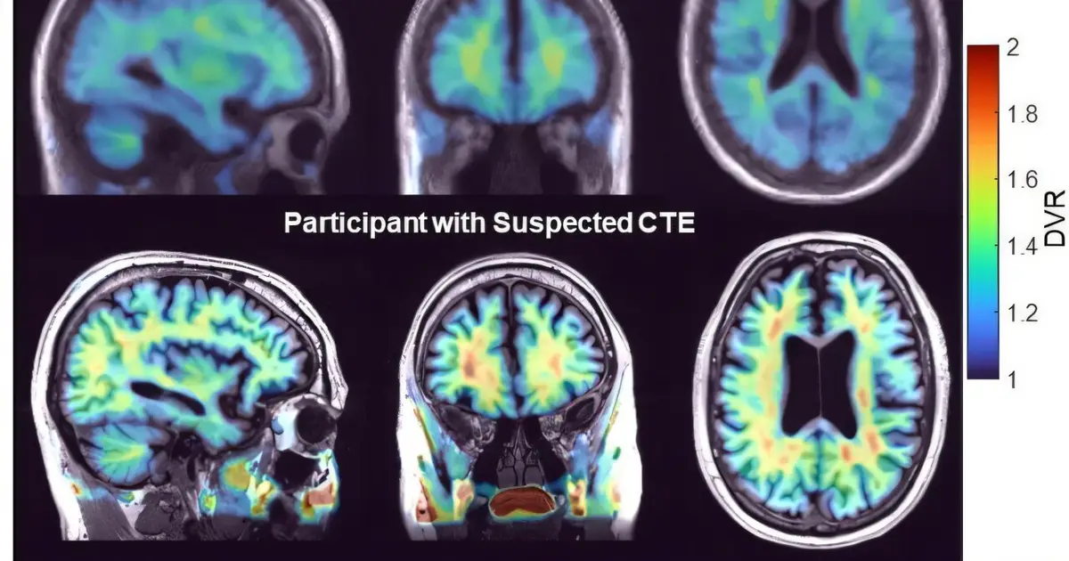 PET suggests potential chronic traumatic encephalopathy biomarker in living humans