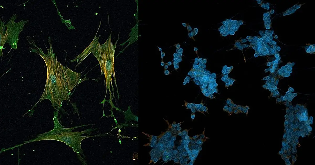 Reprogramming tumor microenvironment could improve prospects for treatment of pancreatic cancer