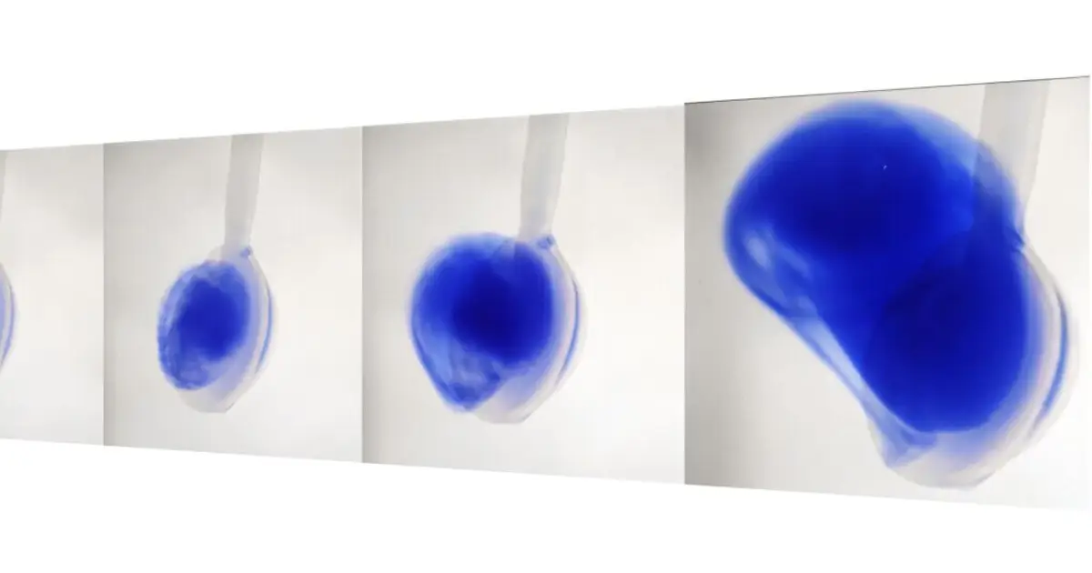 Implant design helps fight ovarian cancer from the inside