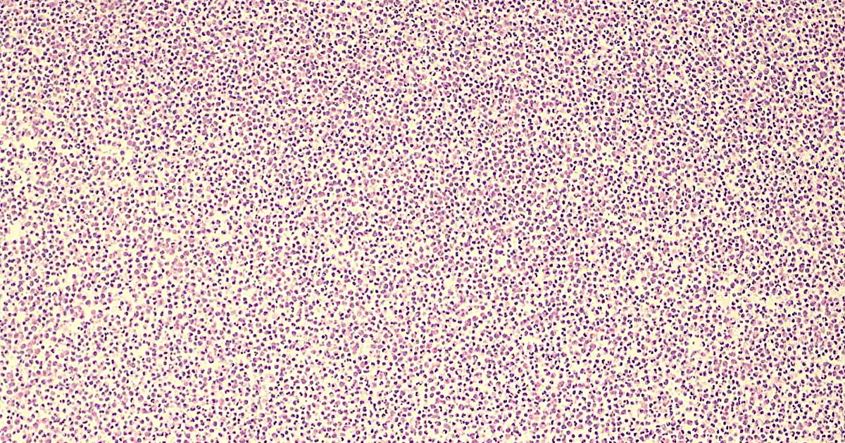 Researchers identify which eye infections pose greatest threat to vision